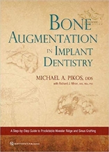 Bone Augmentation in Implant Dentistry: A Step-by-Step Guide to Predictable Alveolar Rid